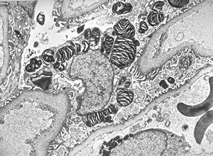 M,27y. | sea-blue histiocyte syndrome M,27y. | sea-blue histiocyte syndrome